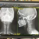 X-ray of my neck after whiplash